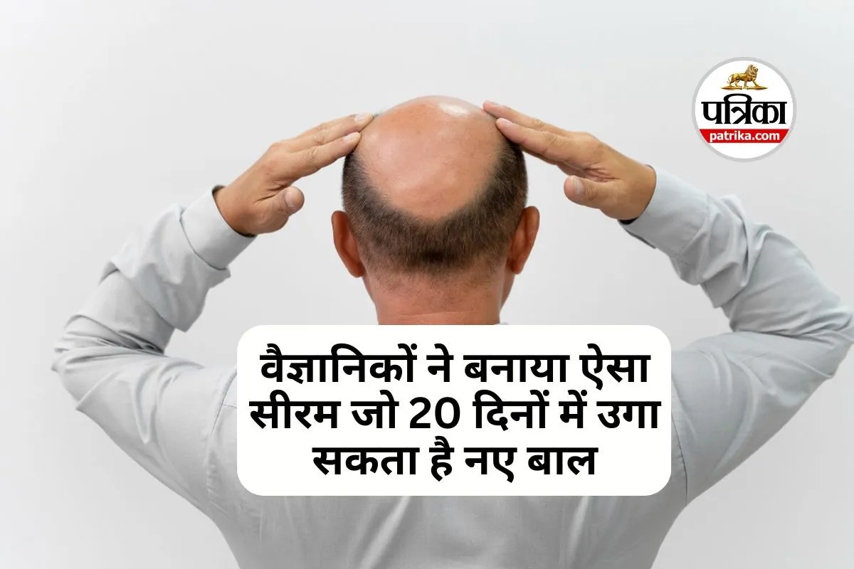 Baldness Cure : चंद दिनों में दूर हो जाएगी गंजेपन की समस्या, वैज्ञानिकों ने तैयार किया अनोखा सीरम!