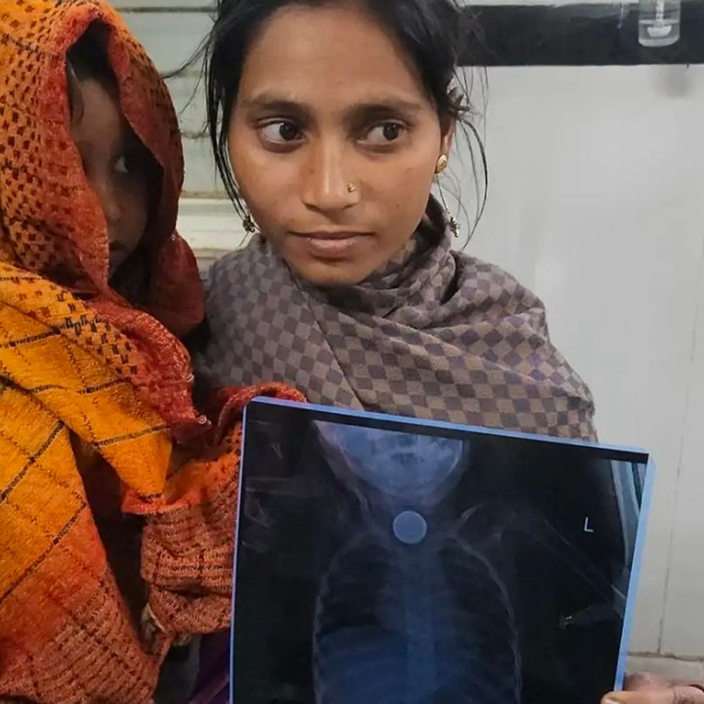 छतरपुर में 8 साल की बच्ची ने सिक्का निगला:डॉक्टर ने बिना ऑपरेशन 2 मिनट में निकाला; अब तक 416 सिक्के निकाल चुके