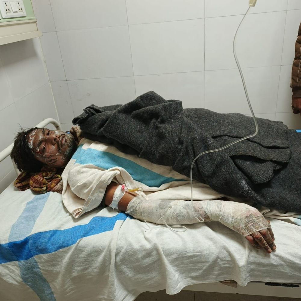 मधेपुरा में तिलकुट दुकान में लगी आग:गैस सिलेंडर लीकेज से खगड़िया के 5 कारीगर झुलसे, मेडिकल कॉलेज में भर्ती