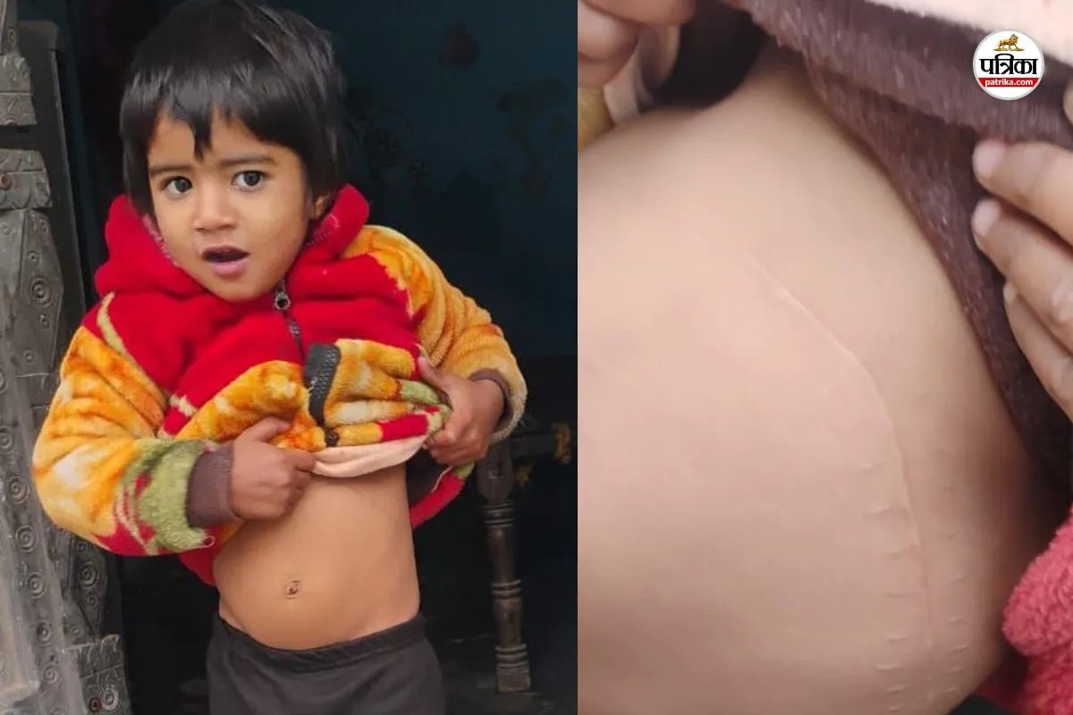 Rajasthan: मासूम बेटे की सर्जरी करवाने मथुरा गया था, डॉक्टरों ने निकाल ली किडनी, 15 लोगों पर FIR