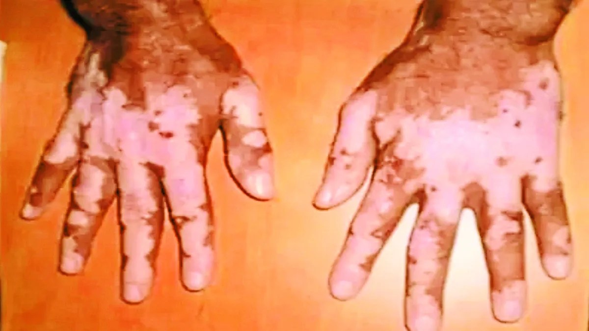 कुष्ठ उन्मूलन : लाखों रुपए खर्च करने के बाद भी कुष्ठ मरीजों की संख्या में बढ़ोतरी