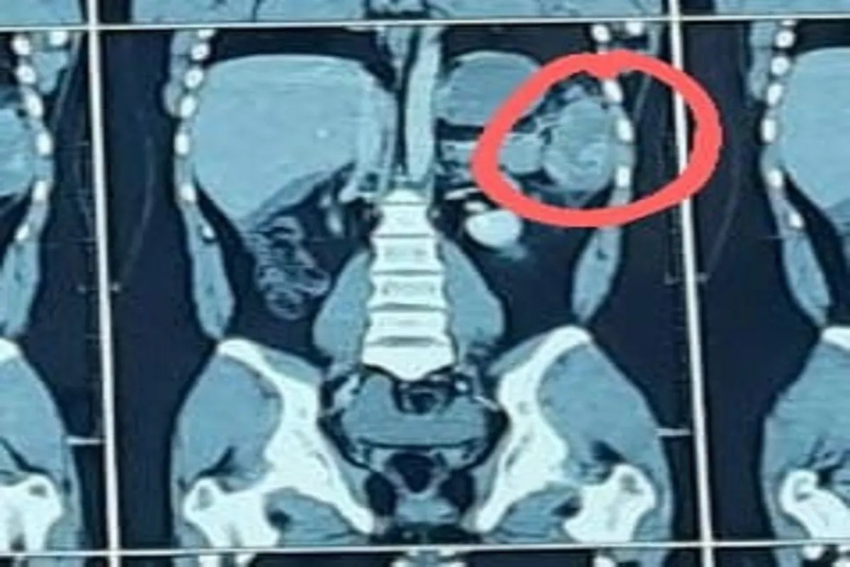 दुर्घटनाओं में तिल्ली की चोट आम, एक ही अस्पताल में 15 वर्ष में 47 की तिल्ली निकाली