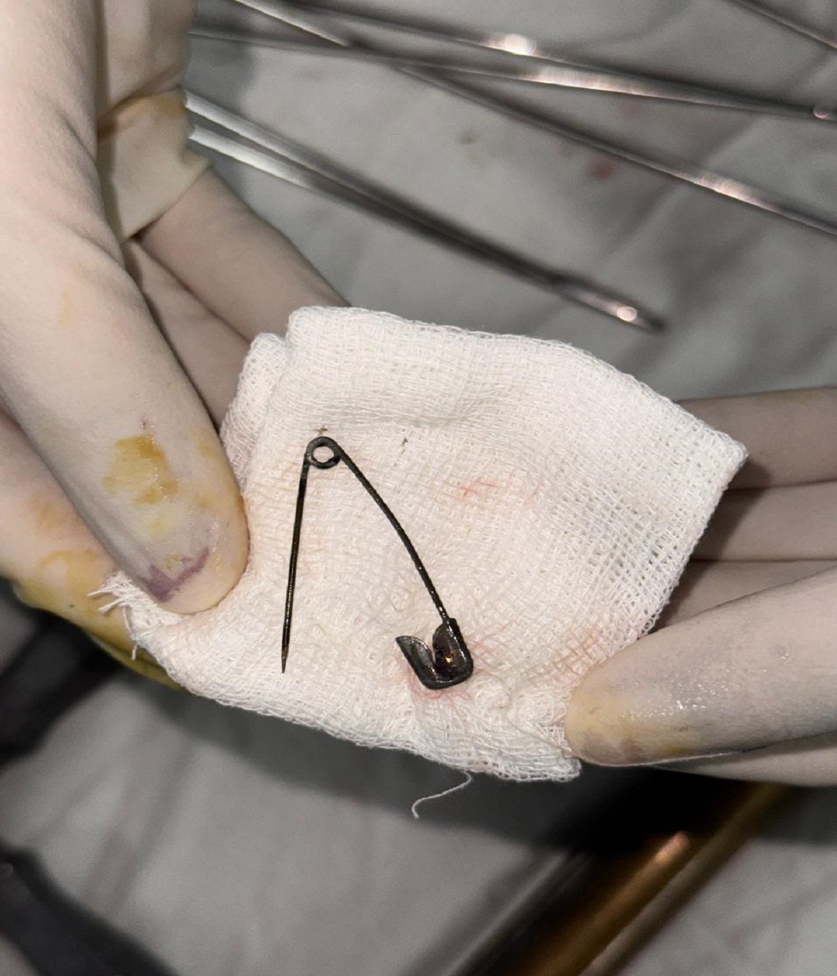 सिविल अस्पताल ने बचाई महिला की जान, गले में फंसी सेफ्टी पिन निकाली