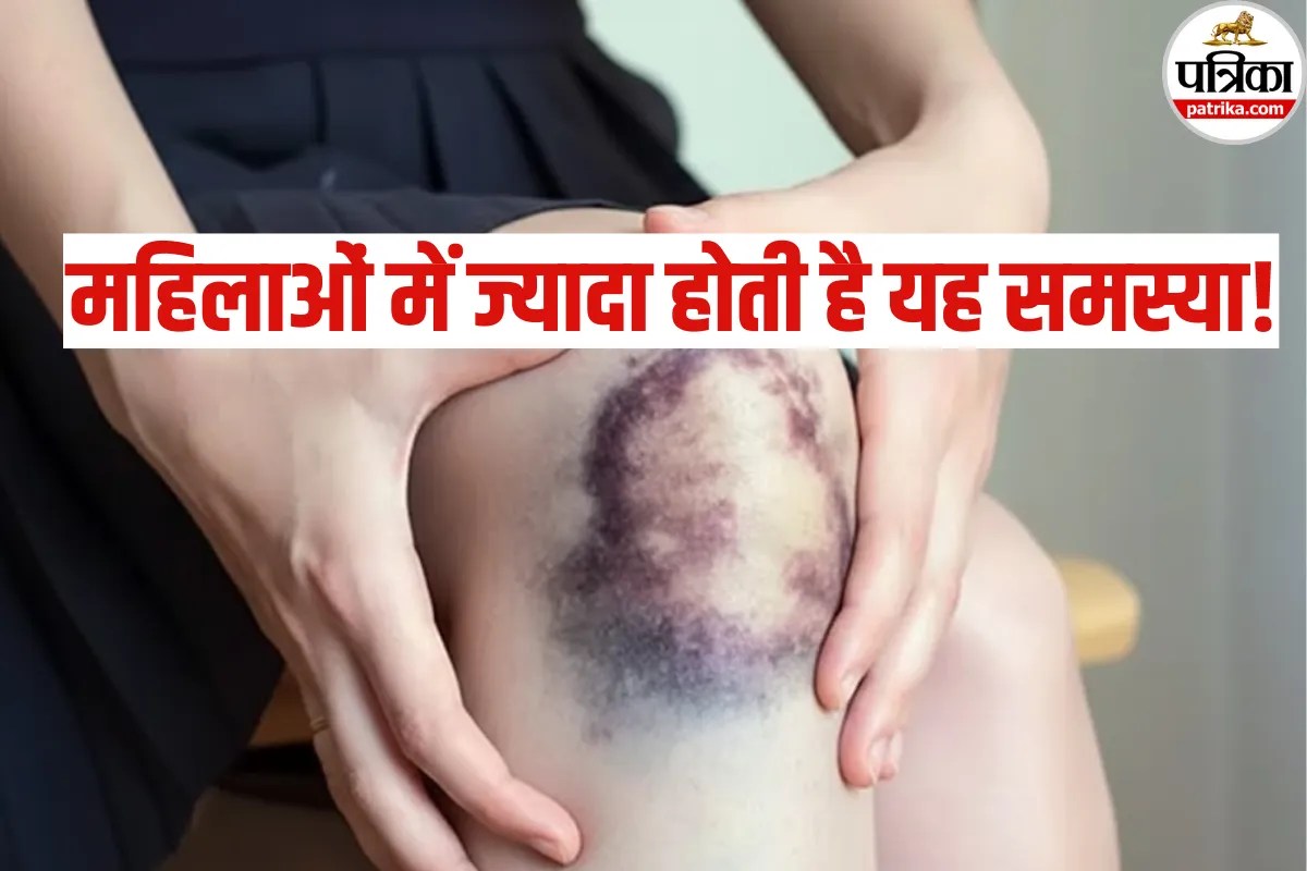 Bruising without Injury: शरीर पर अचानक नीले निशान आते हैं? सावधान! कहीं ये गंभीर बिमारियों का संकेत तो नहीं
