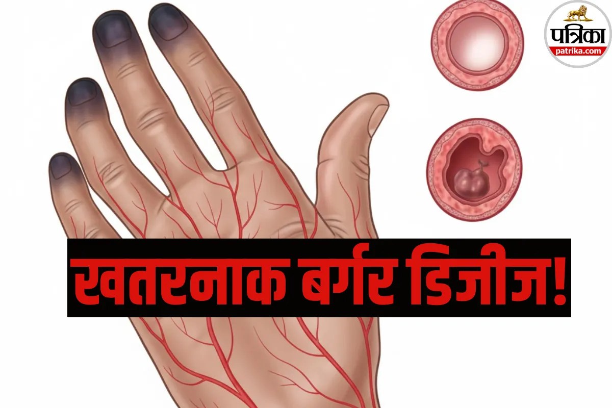 Buerger Disease: युवाओं के लिए खतरे की घंटी! तेजी से फैल रही है बर्गर डिजीज, अभी जानें इसके लक्षण और बचाव?