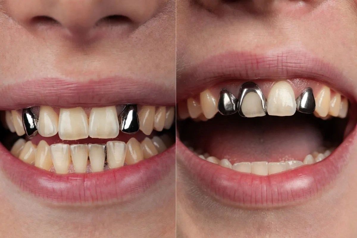 अब मुस्कुराना भी हुआ महंगा! जानिए कैसे चांदी के भाव बढ़ने से ‘डेंटल फिलिंग’ हुई महंगी