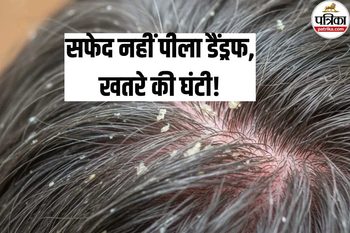 HIV Cause: सिर की खुजली को न करें नजरअंदाज, हो सकती है ये खतरनाक बीमारी! अभी जानें डैंड्रफ और HIV का संबंध