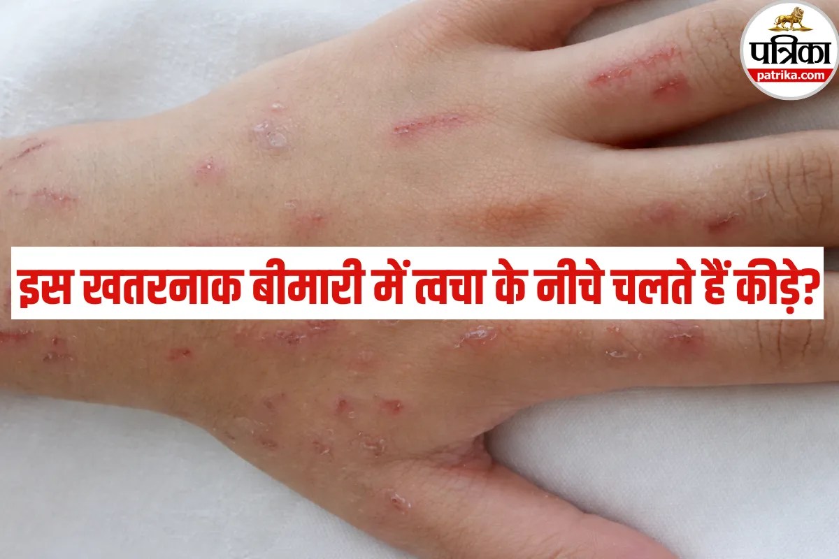 Skin Disease: जब शरीर खुद बनाने लगे रंगीन धागे और त्वचा के नीचे महसूस हो कीड़ों का चलना! जानें क्या है यह रहस्यमयी बीमारी