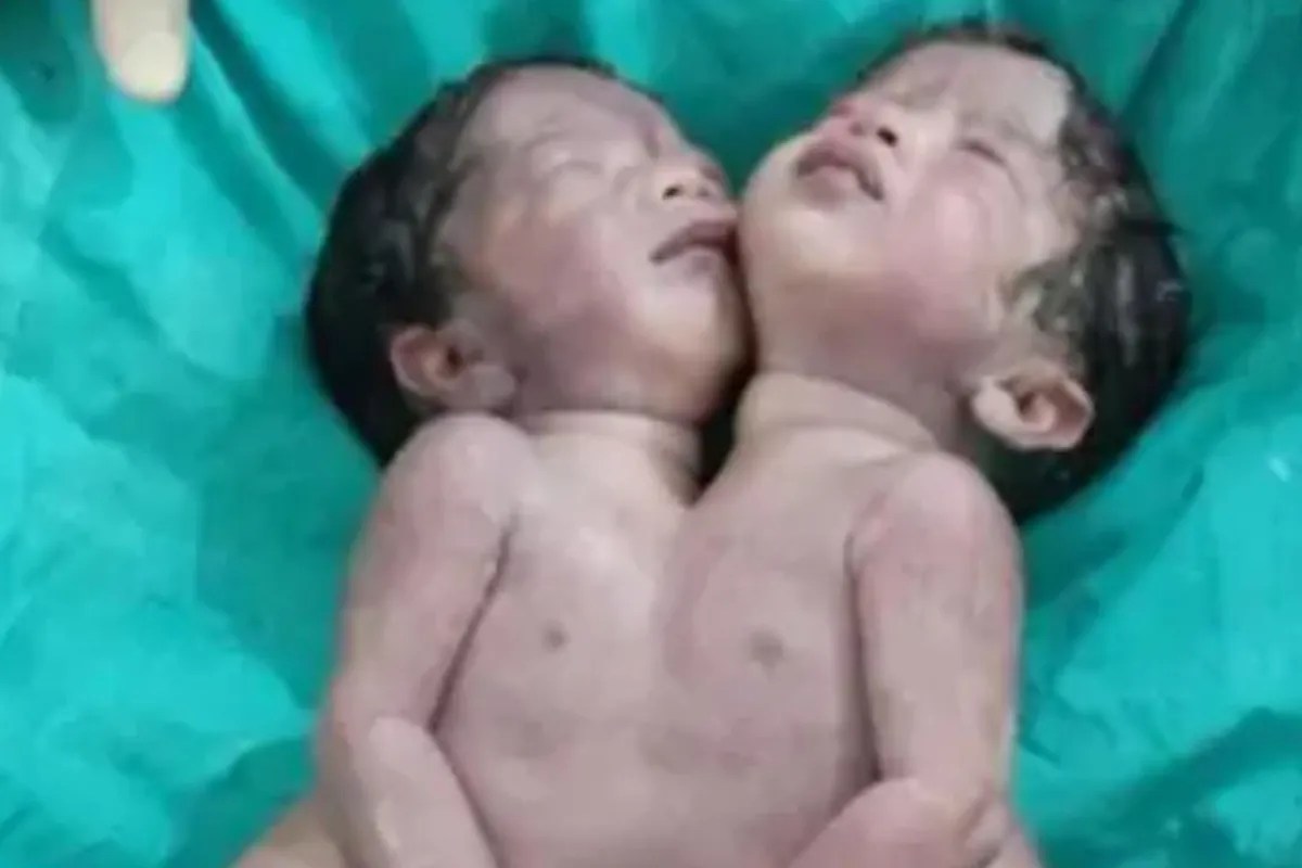 महराजगंज में जन्मे नवजात को देख चौंके लोग, डॉक्टर बोले… दो लाख में आता है ऐसा एक केस