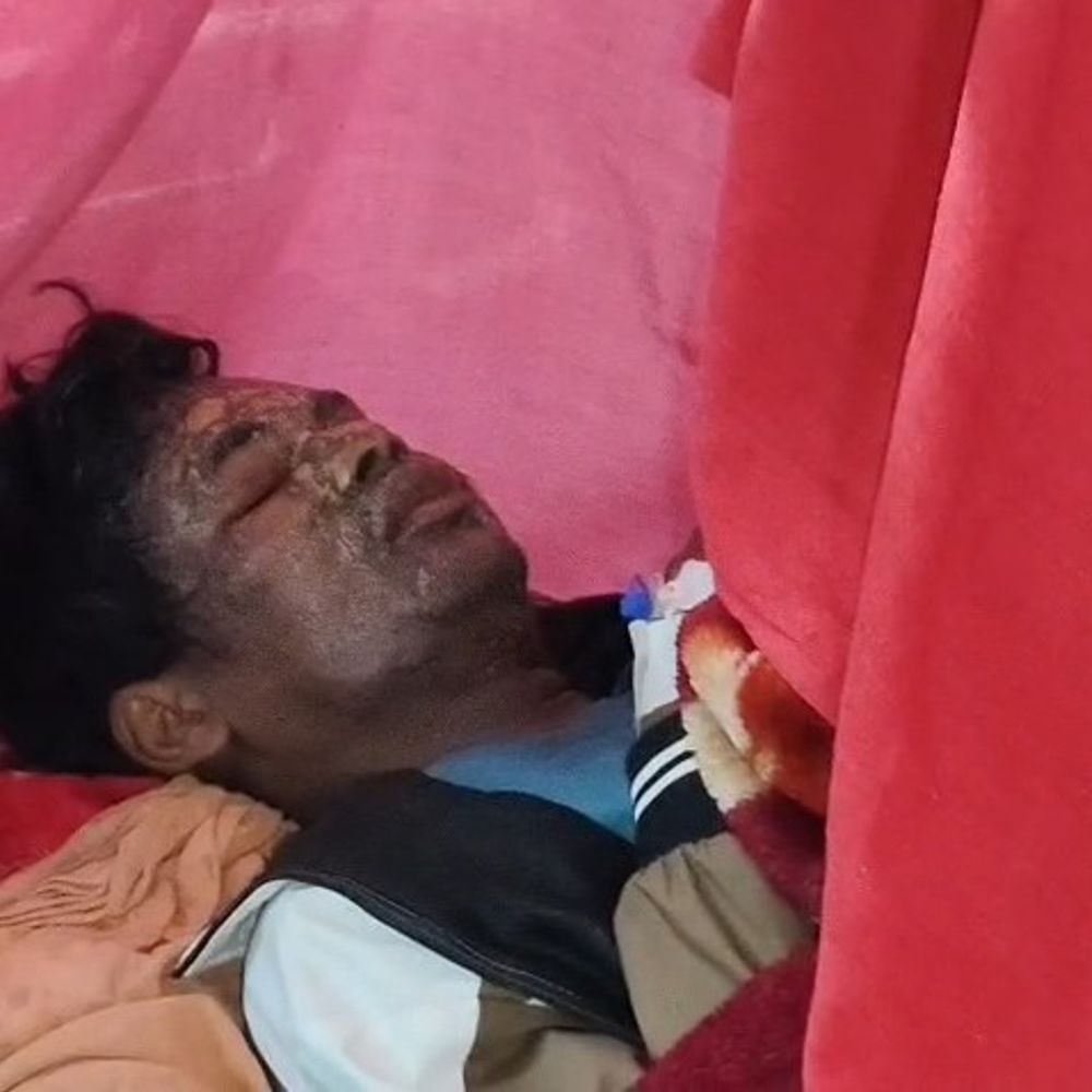 कुशीनगर में दोस्त पर केमिकल फेंका:युवक का चेहरा झुलसा, आंखें चोटिल; आरोपी गिरफ्तार