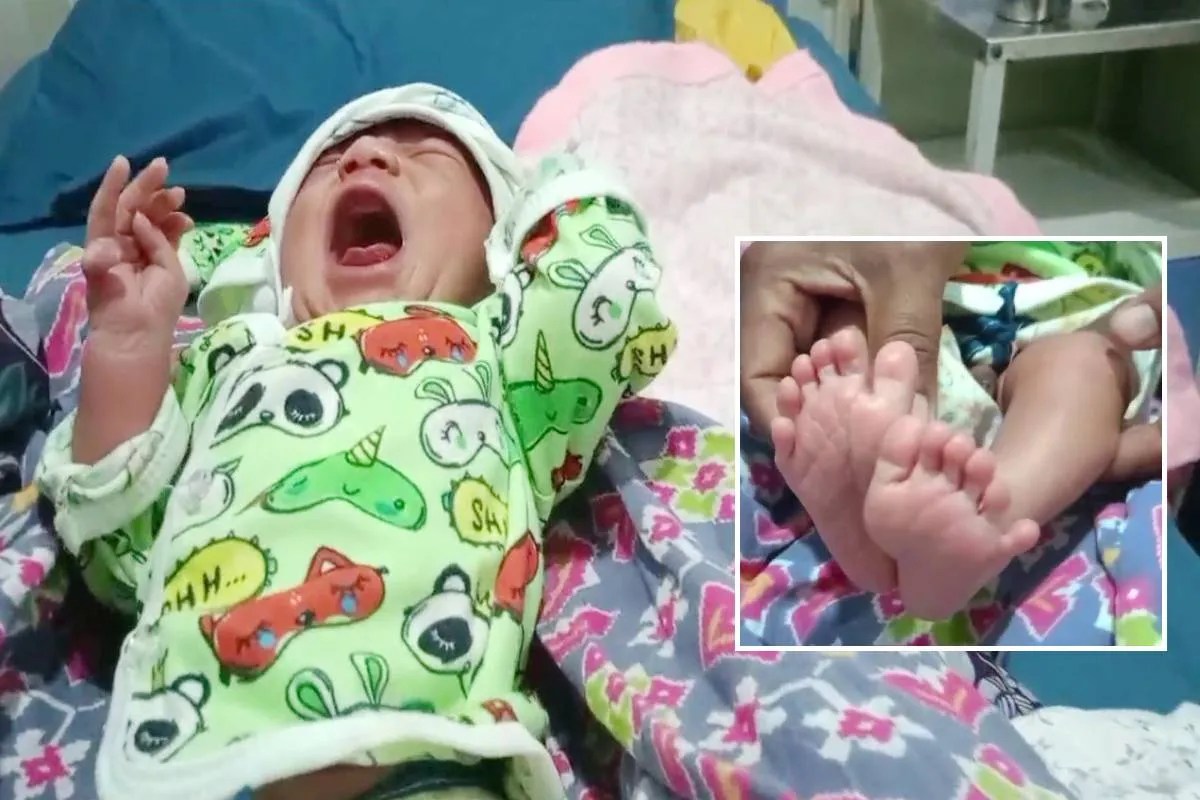 एमपी में 24 उंगलियों के साथ जन्मी अनोखी बच्ची, डॉक्टर भी हैरान