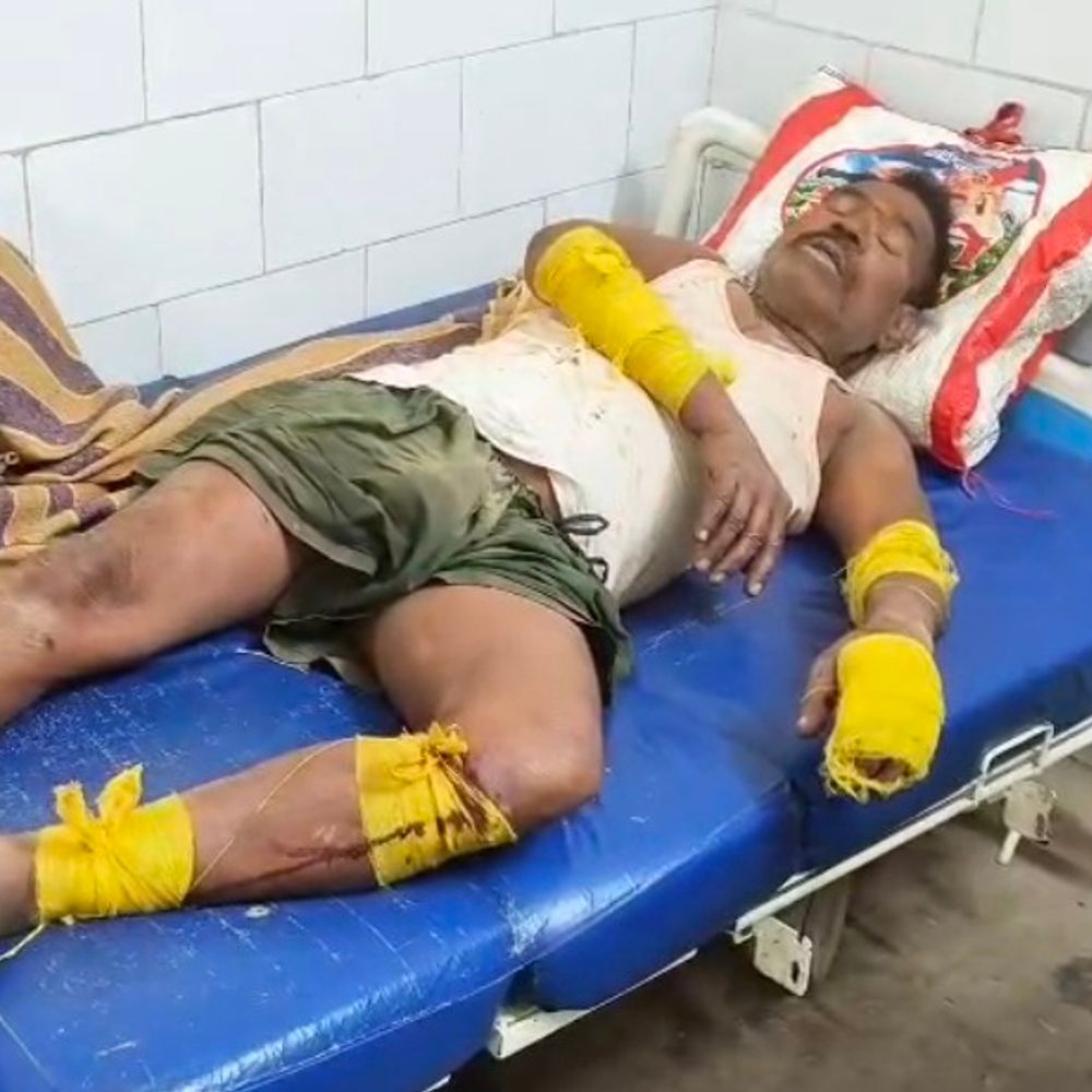 सीधी में यूकेलिप्टस काटने पर चाचा को पीटा:भतीजों ने लाठी-डंडों से हमला कर पैर फ्रैक्चर किया; अस्पताल में एडमिट