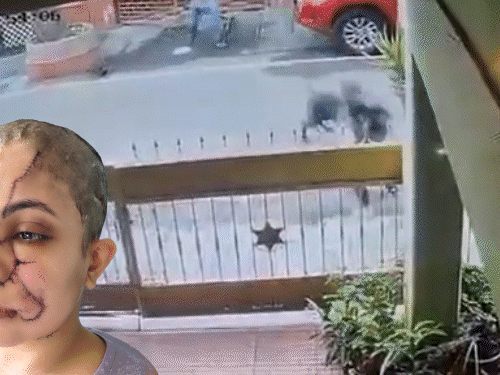 बेंगलुरु में पालतू कुत्ते का महिला पर हमला, VIDEO:चेहरे-गर्दन पर काटा, 50 से ज्यादा टांके आए; बचाने आए युवक पर भी झपटा