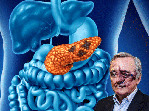 स्पेन के वैज्ञानिकों ने पैंक्रियाटिक कैंसर का इलाज खोजा:6 साल चूहों पर रिसर्च में कामयाबी; इसी से एपल CEO स्टीव जॉब्स की जान गई थी