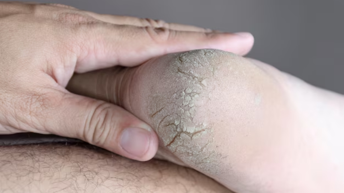फटी एड़ियों को रातभर में कैसे ठीक करें, इस उपाय को करने से एकदम मुलायम हो जाएंगी एड़ियां