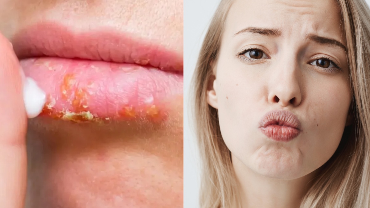 ठंड से सूख गए हैं होंठ, जमने लगी है पपड़ी तो आज़माए ये देसी उपाय, कुछ ही दिन में लिप्स होंगे सॉफ्ट