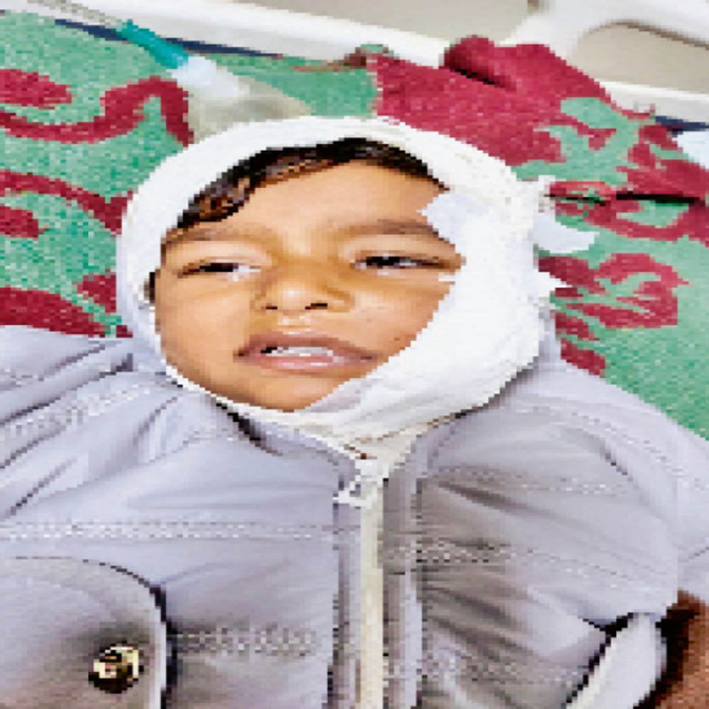 कुत्ते के काटने से घायल बच्चे के चेहरे पर 14 और पैर में तीन टांके आए, एक घंटे चला ऑपरेशन