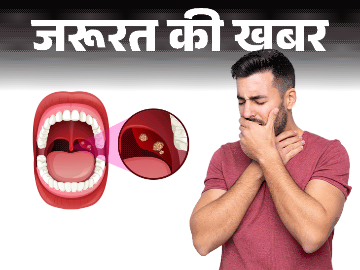 जरूरत की खबर- गले में दर्द हो सकता है टॉन्सिलाइटिस:डॉक्टर से जानें ये क्या है, क्यों होता है, लक्षण और बचाव की जरूरी सावधानियां