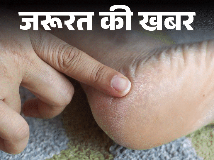 जरूरत की खबर- सर्दियों में फटती हैं एड़ियां:डर्मेटोलॉजिस्ट से जानें कैसे करें ठीक, क्रैक्ड हील्स को मुलायम बनाने के 9 स्टेप्स