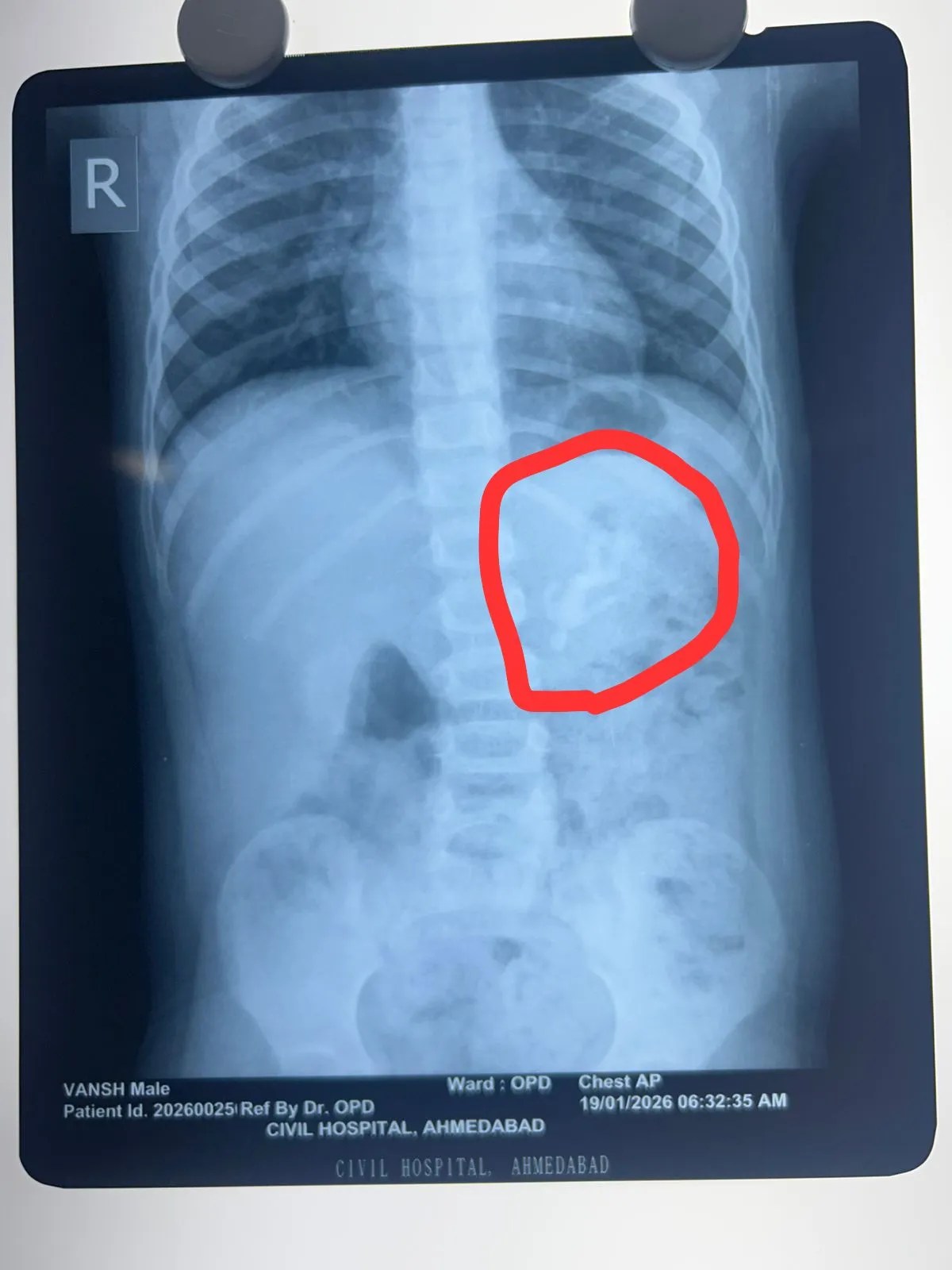 जटिल सर्जरी कर बच्चे के पेट से निकाला प्लास्टिक का खिलौना