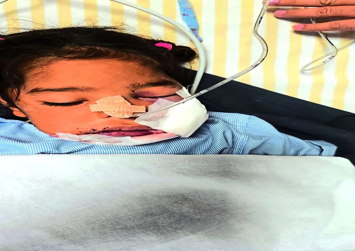 टॉफी चबाते ही बच्ची के मुंह में विस्फोट, जबड़ा फटा