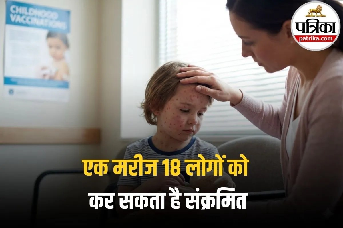 Khasra Symptoms in Child: खसरे ने मचाया हड़कंप! 14 हजार से ज्यादा केस, एक मरीज 18 लोगों को कर सकता है संक्रमित