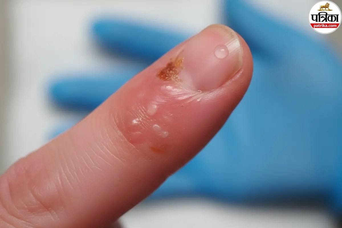 Skin Disease: उंगलियों को खत्म कर रहा ये खतरनाक वायरस! अभी जानें क्या होता है Whitlow