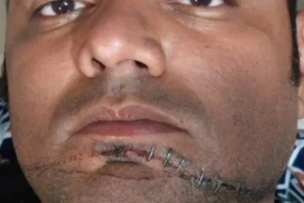 कब चेतेगा गोरखपुर का प्रशासन…चाइनीज मांझे से बुलेट सवार का चेहरा कटा, सड़क पर गिरकर घायल…गाल पर लगे 8 टांके