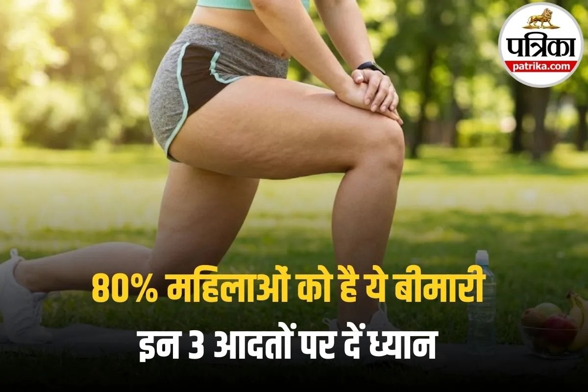Women Cellulite Causes: सेल्युलाईट क्या है और महिलाओं में क्यों होता है? जानिए इसे कम करने के असरदार तरीके
