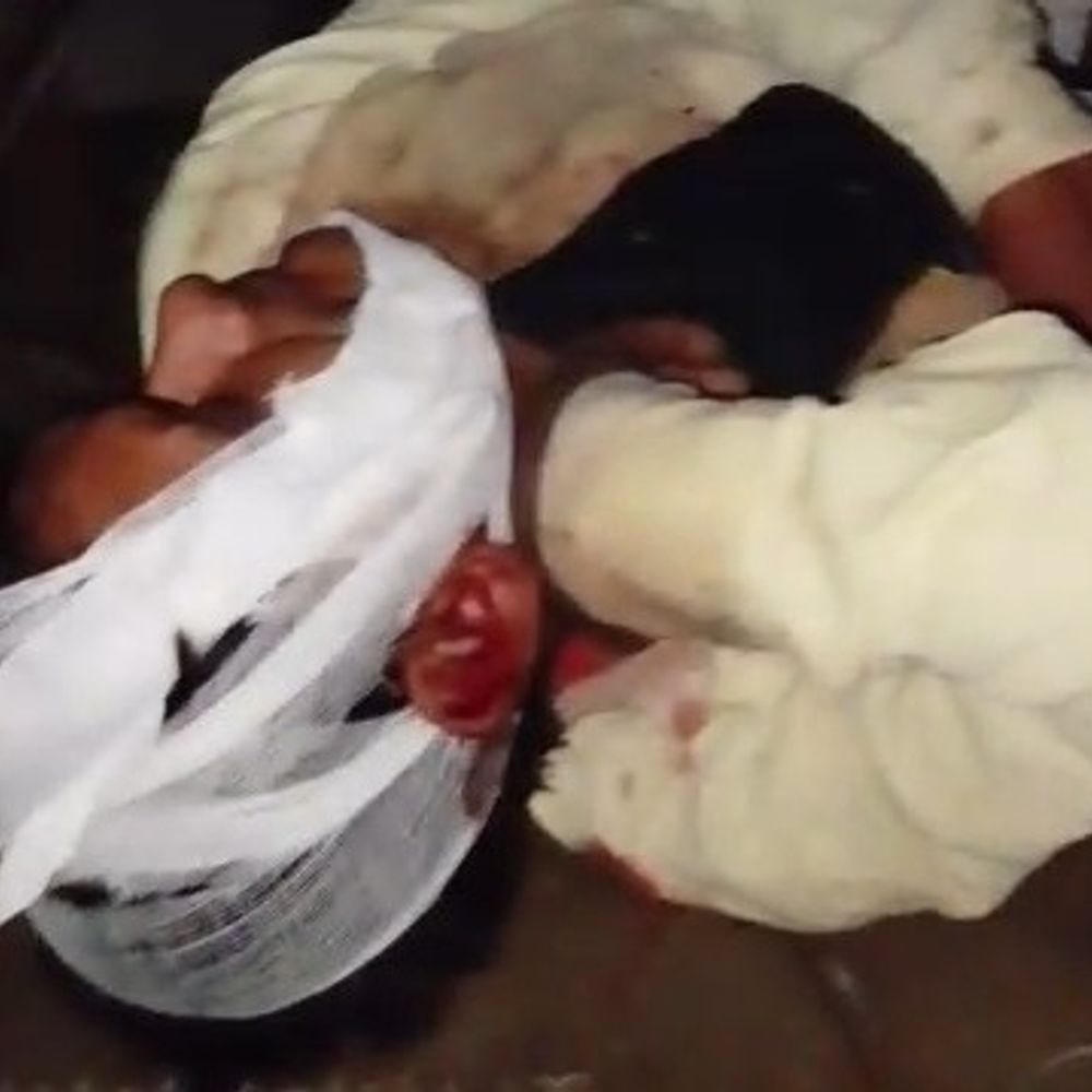 गोंडा में युवक पर जानलेवा हमला:पुरानी रंजिश में हॉकी और लाठी-डंडों से पीटा, मेडिकल कॉलेज में भर्ती