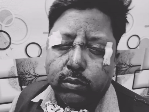 फाइनेंस कंपनी कर्मचारी चाइनीज मंझे से जख्मी:सिविल लाइंस में बाइक से घर लौटते वक्त हुआ हादसा, आंख के पास गंभीर चोट, सात टांके लगे