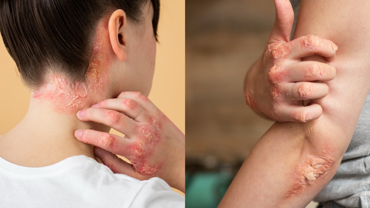 स्किन कंडीशन एक्जिमा और सोरायसिस में क्या है ज़्यादा खतरनाक? एक्सपर्ट से जानें बचाव के तरीके