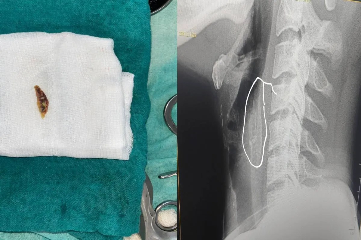 गले में फंसी चिकन के लेग पीस की हड्डी, दर्द से छटपटा रहे युवक की करनी पड़ी सर्जरी