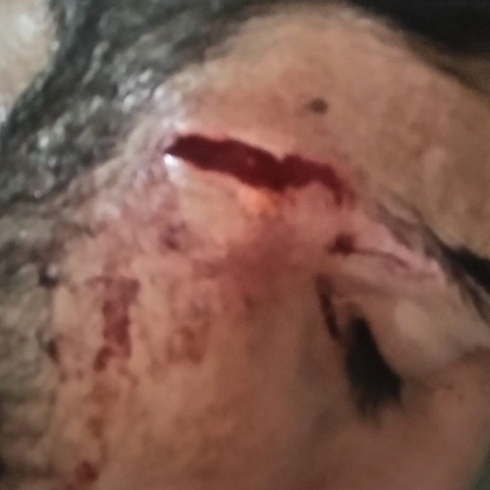 झज्जर में बंदरों का आतंक, युवक व महिला को काटा:बस में चढते समय किया हमला, गुरुग्राम से आएगी पकड़ने के लिए टीम