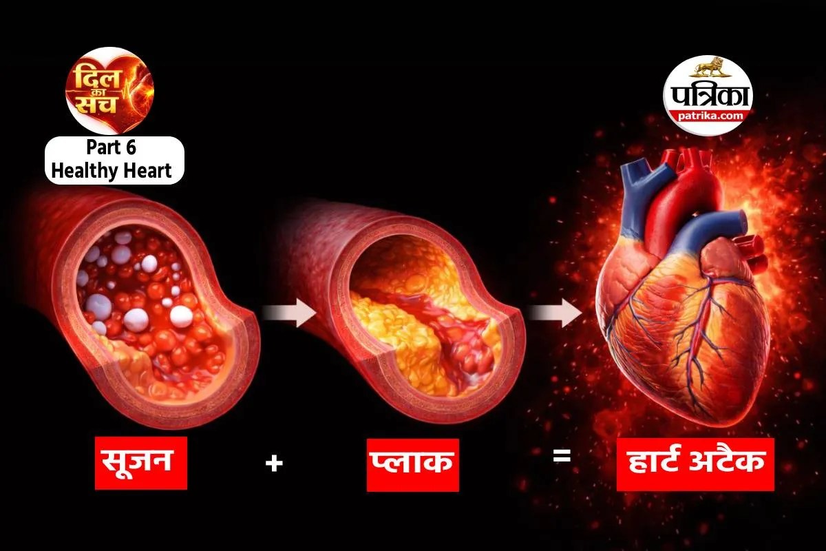 आपकी नसों में भी प्लाक/ब्लॉकेज! जानें क्या है? कैसे बनता है और कब बढ़ाता है हार्ट अटैक रिस्क?