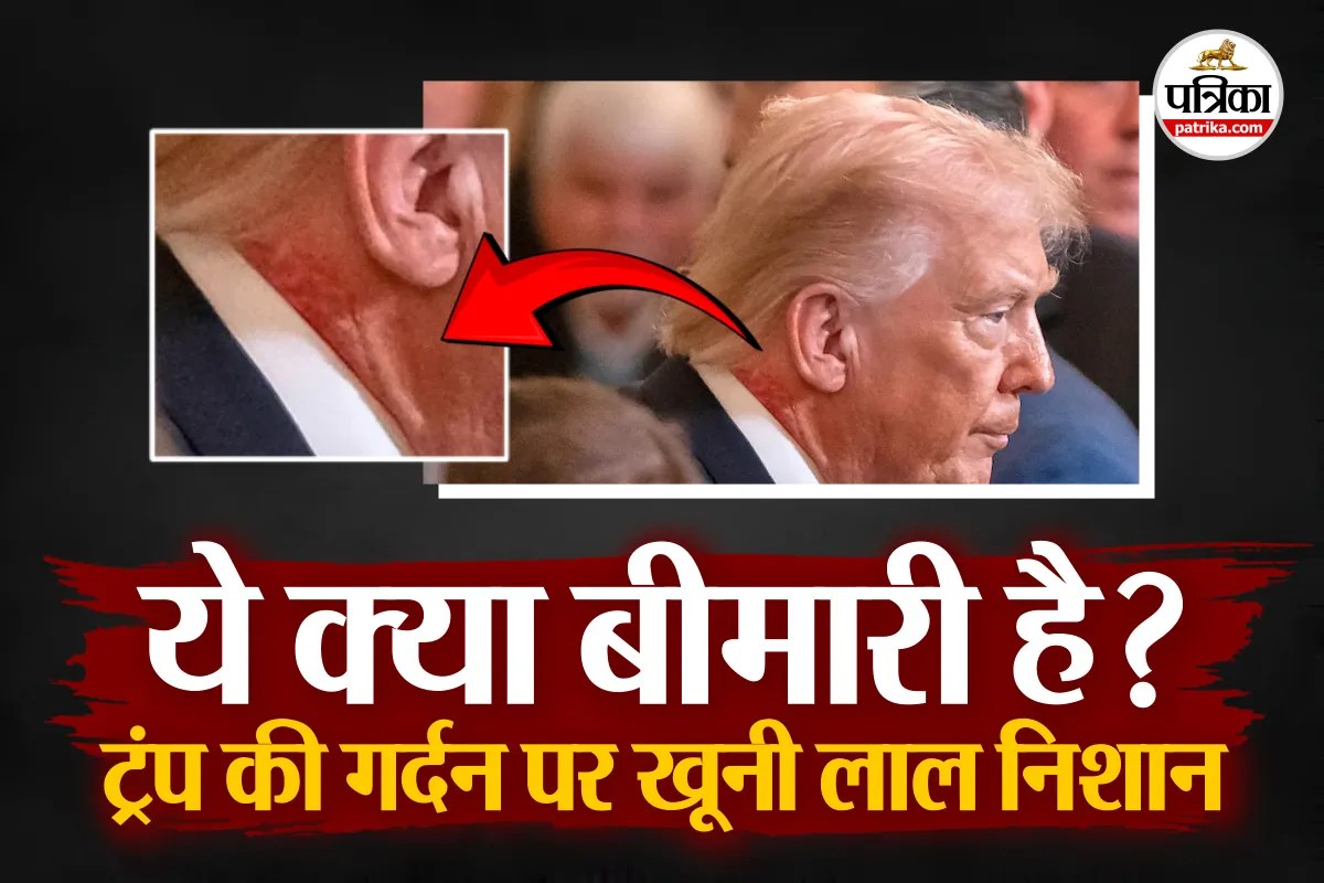 Trump Neck Skin Issue : ट्रंप की गर्दन पर खून जैसे लाल रैशेज, बीमारी या कुछ और? व्हाइट हाउस के डॉक्टर ने बताया