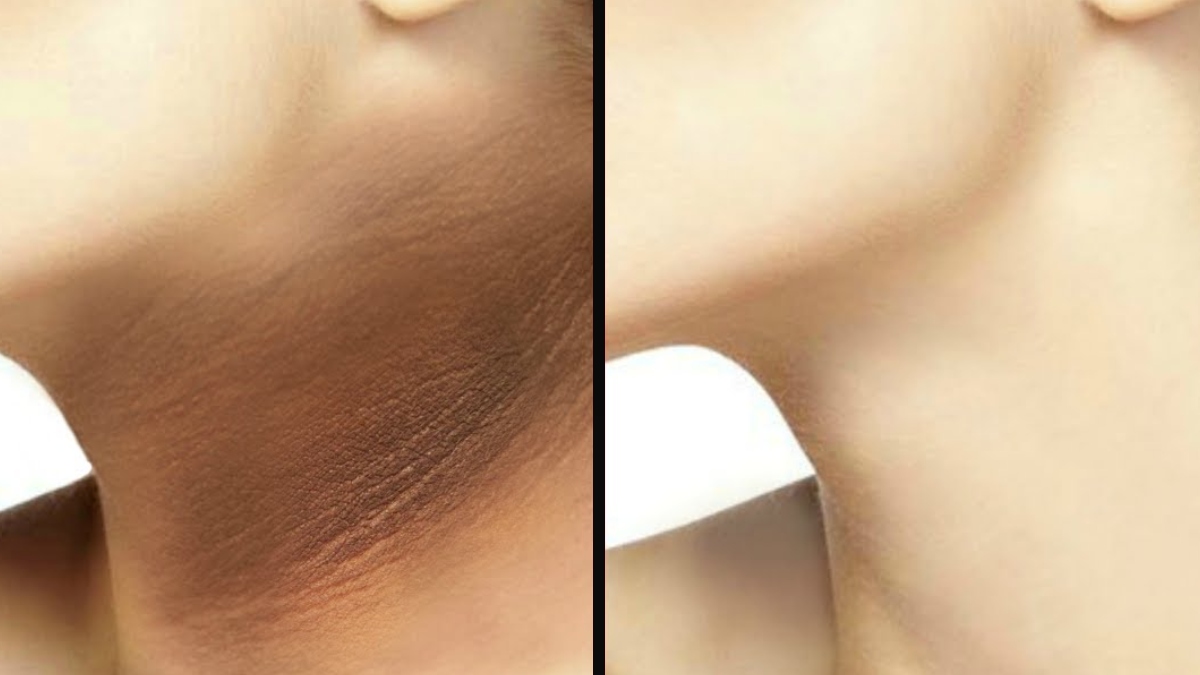 गर्दन के कालेपन को दूर करने के लिए क्या लगाएं, अपनाएं देसी नुस्खे, निकल जाएगा सारा मैल