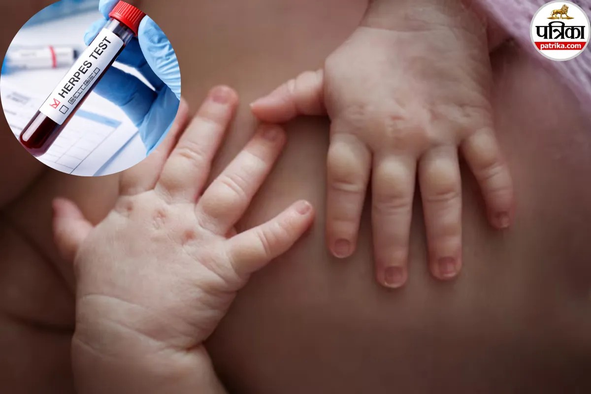Herpes Virus: इजराइल में रस्म निभाने के चक्कर में बच्चे को लगी ऐसी बीमारी, 2 हफ्ते के बच्चे के दिमाग तक पहुंचा जहर!
