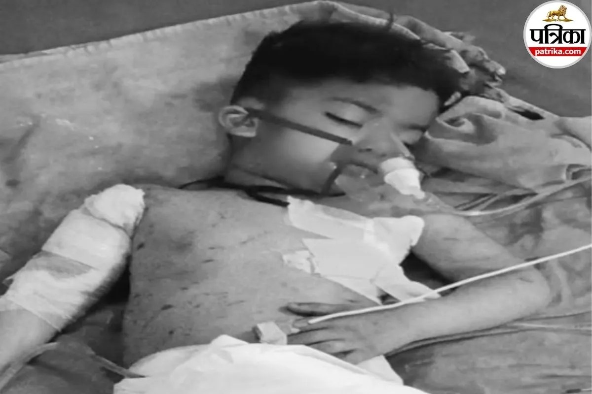 आवारा कुत्तों का कहर… मुर्गी फार्म के बाहर खेल रहे मासूम को झुंड ने नोचा, आंतें बाहर निकलीं, हालत गंभीर