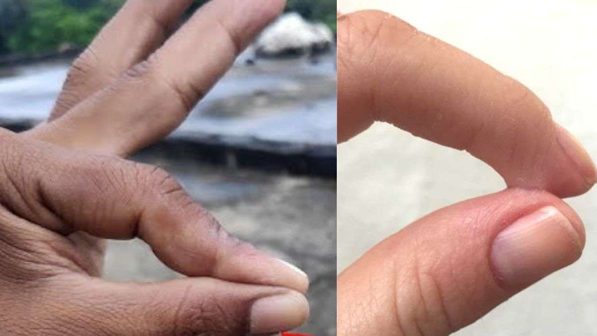 फेवीक्विक से चिपक गई हैं उंगलियां? तो इस ट्रिक से बिना दर्द के छूटेंगे चिपके Fingers