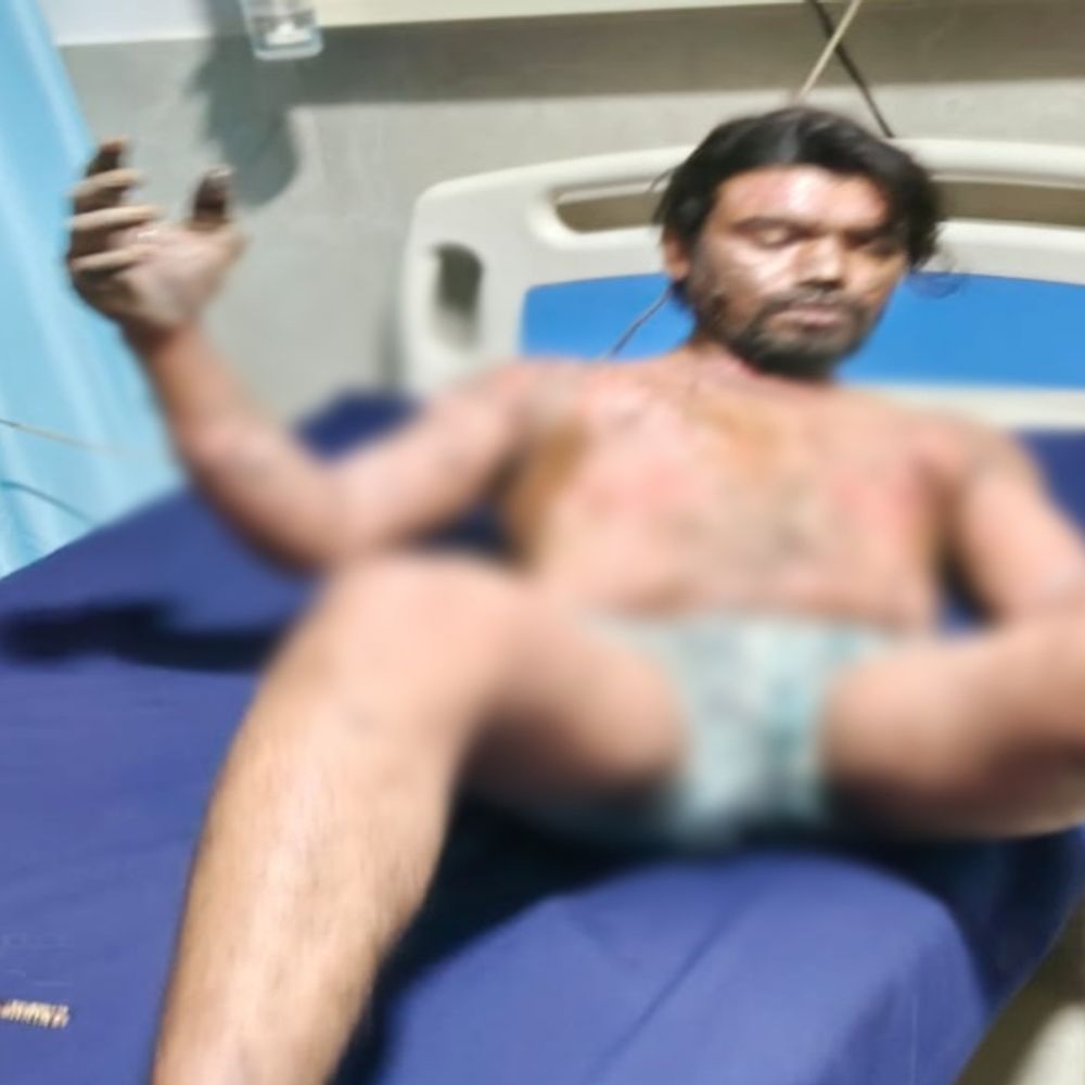 बिलासपुर के नोवा स्पंज-आयरन प्लांट में हादसा…4 मजदूर झुलसे:फर्नेश में मजदूरों पर गिरा खौलता लोहा, घायल बोले-बिना सुरक्षा किट दिए प्रबंधन ले रहा काम