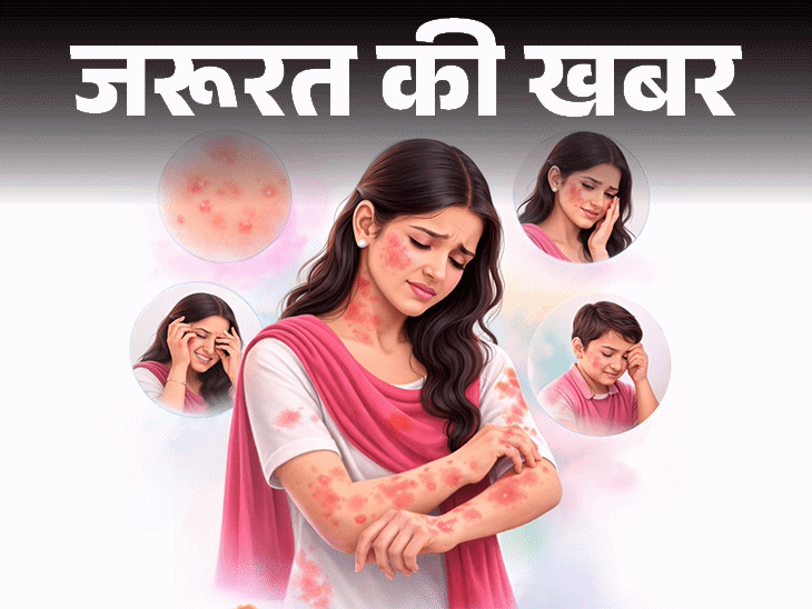 जरूरत की खबर- होली रंगों से स्किन पर रैशेज, दाने:डर्मेटोलॉजिस्ट से जानें 10 घरेलू इलाज, ये 6 संकेत दिखें तो तुरंत डॉक्टर को दिखाएं