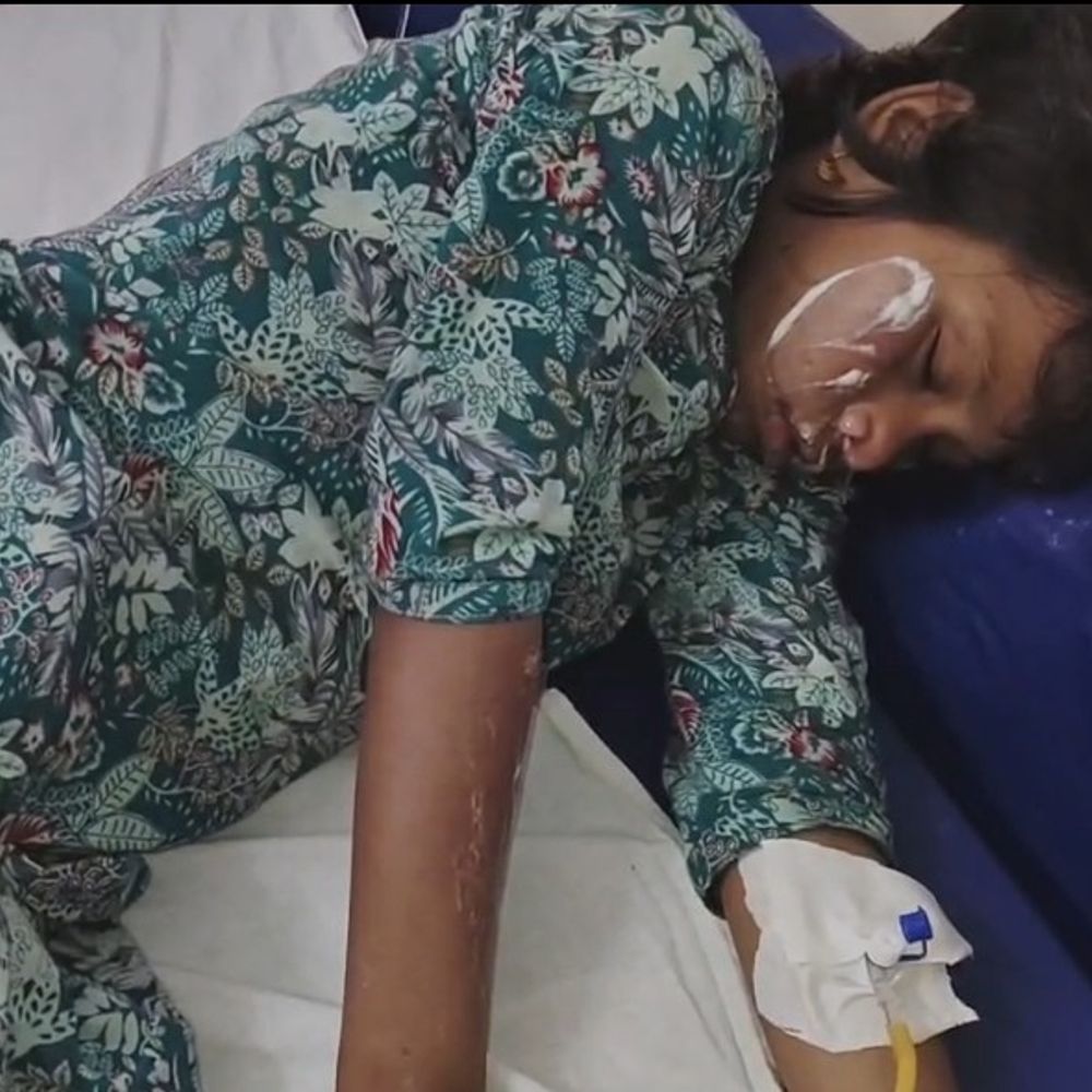 श्रावस्ती में गैस रिसाव से लगी थी आग:मूकबधिर पिता समेत तीन बच्चे झुलसे, हालत गंभीर, बहराइच इलाज के बाद लखनऊ रेफर