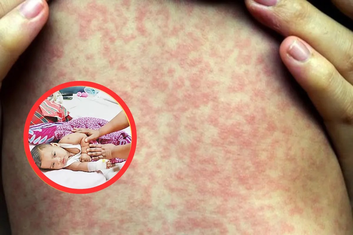 बांग्लादेश में तेजी से फैल रही है ये बीमारी, अब तक 118 लोगों की मौत, ज्यादातर बच्चे हुए शिकार