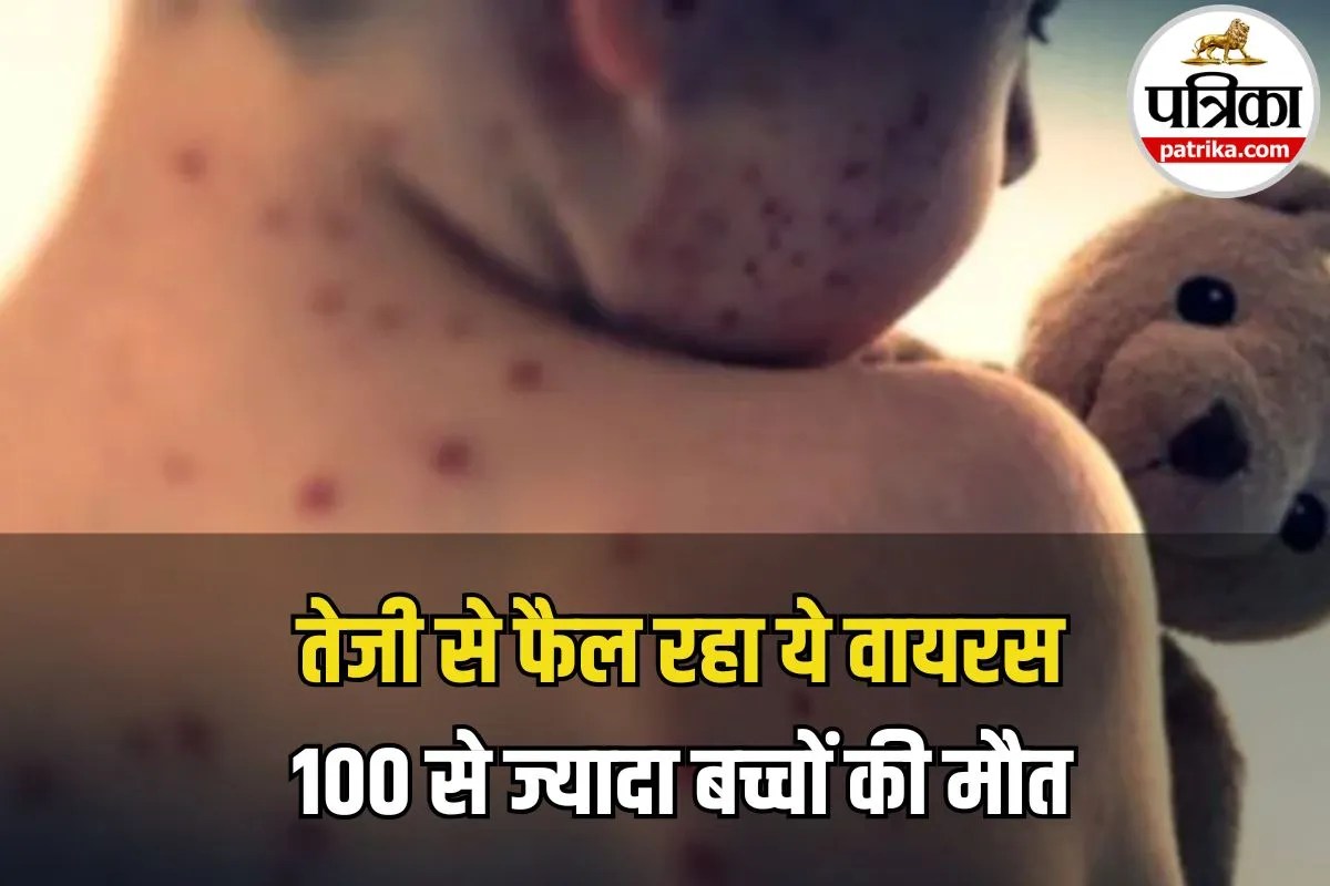Measles Outbreak Alert: बांग्लादेश में खसरे का खौफ! 100 से ज्यादा बच्चों की मौत, आखिर क्यों फैल रही है ये खतरनाक बीमारी?
