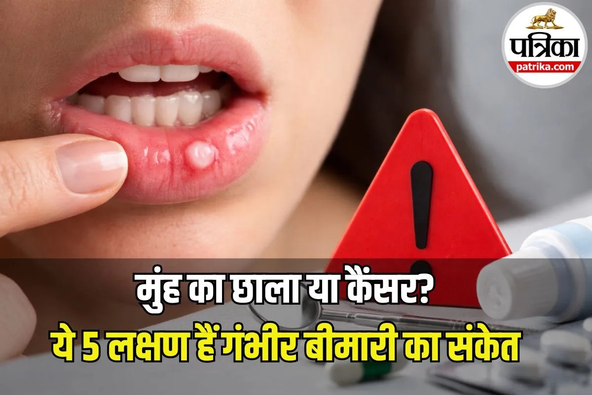 Oral Cancer Symptoms: मुंह के छालों को न समझें मामूली, डॉक्टर ने बताया ये 5 लक्षण हैं गंभीर बीमारी का संकेत