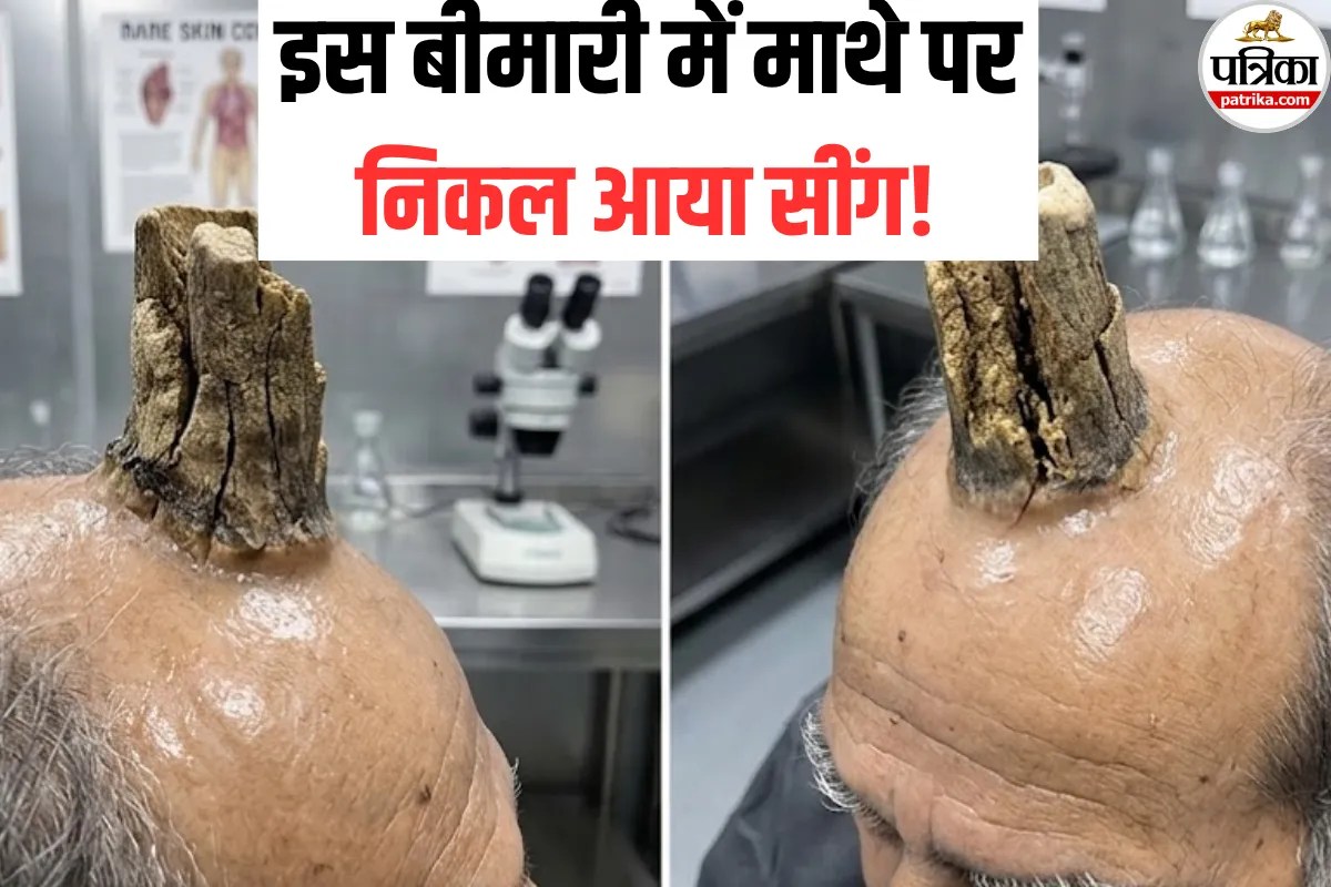 Sebaceous Horn: इंसान के माथे पर निकले ‘शैतानी सींग’! डॉक्टर ने बताया इस खतरनाक बीमारी का कारण
