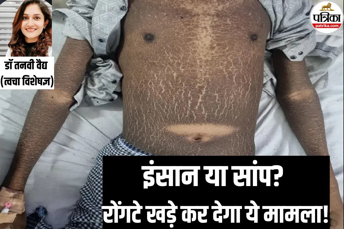 सांप जैसा शरीर! दुर्लभ बीमारी का पहला मरीज बना रायपुर का 19 वर्षीय युवक, डॉक्टर से जानें X-linked Ichthyosis क्या होता है