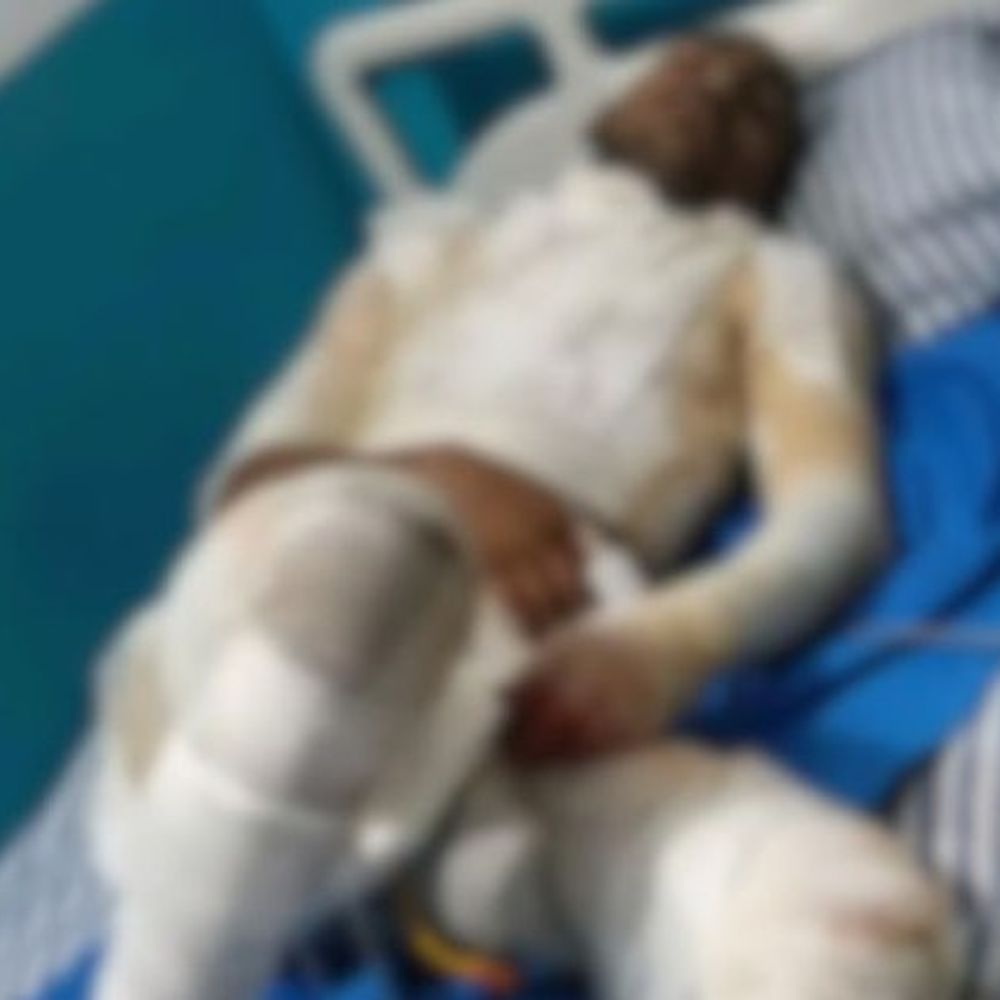 पेट्रोल डालकर जलाया गया युवक, दिल्ली एम्स में मौत:मोतिहारी में 17 अप्रैल की रात तीन बाइक सवारों ने लगाई थी आग, FIR दर्ज