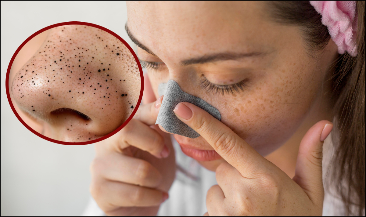 ब्लैकहेड्स हटाने के असरदार तरीके, निकल जाएगी रोमछिद्रों में भरी गंदगी, चमक उठेगा चेहरा